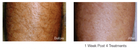 Laser Clean Hair Removal