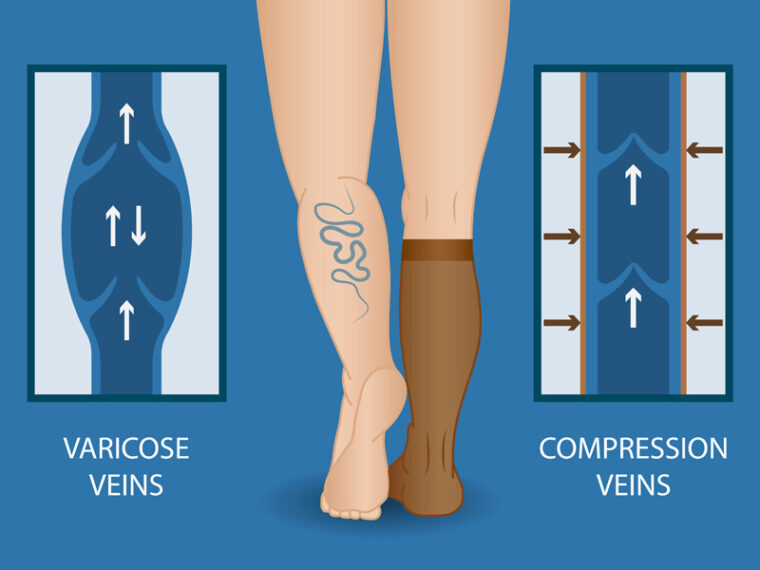 Compression Stocking Benefits After Varicose Vein treatment