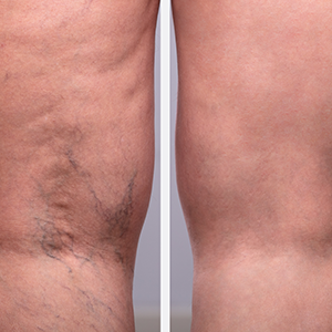 especialista en venas cerca de mí