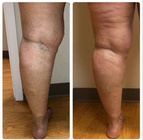 Veins before and after Varicose