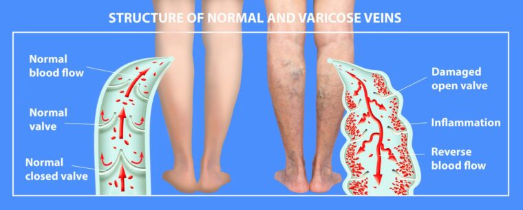 The Type Recurrent Varicose Veins