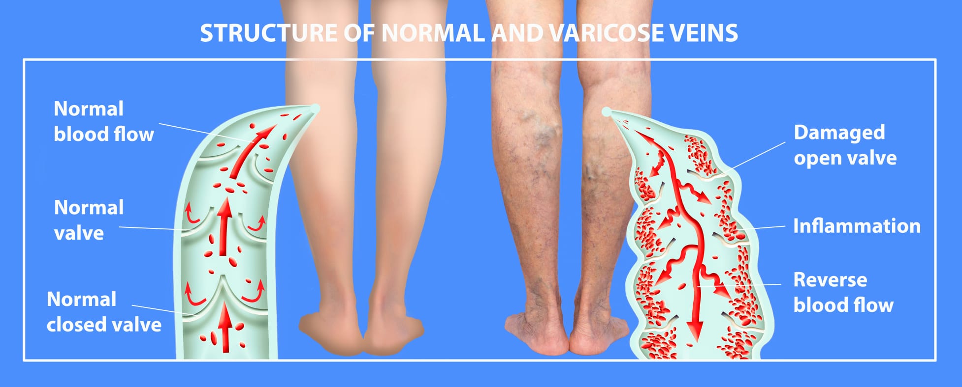 The Type Recurrent Varicose Veins