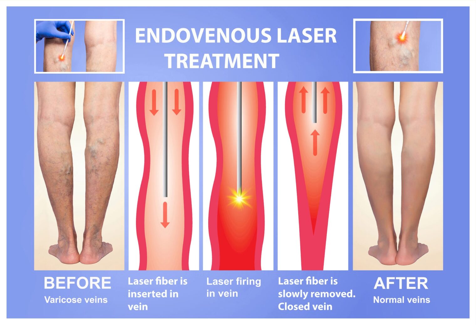 The Endovenous Laser Treatment