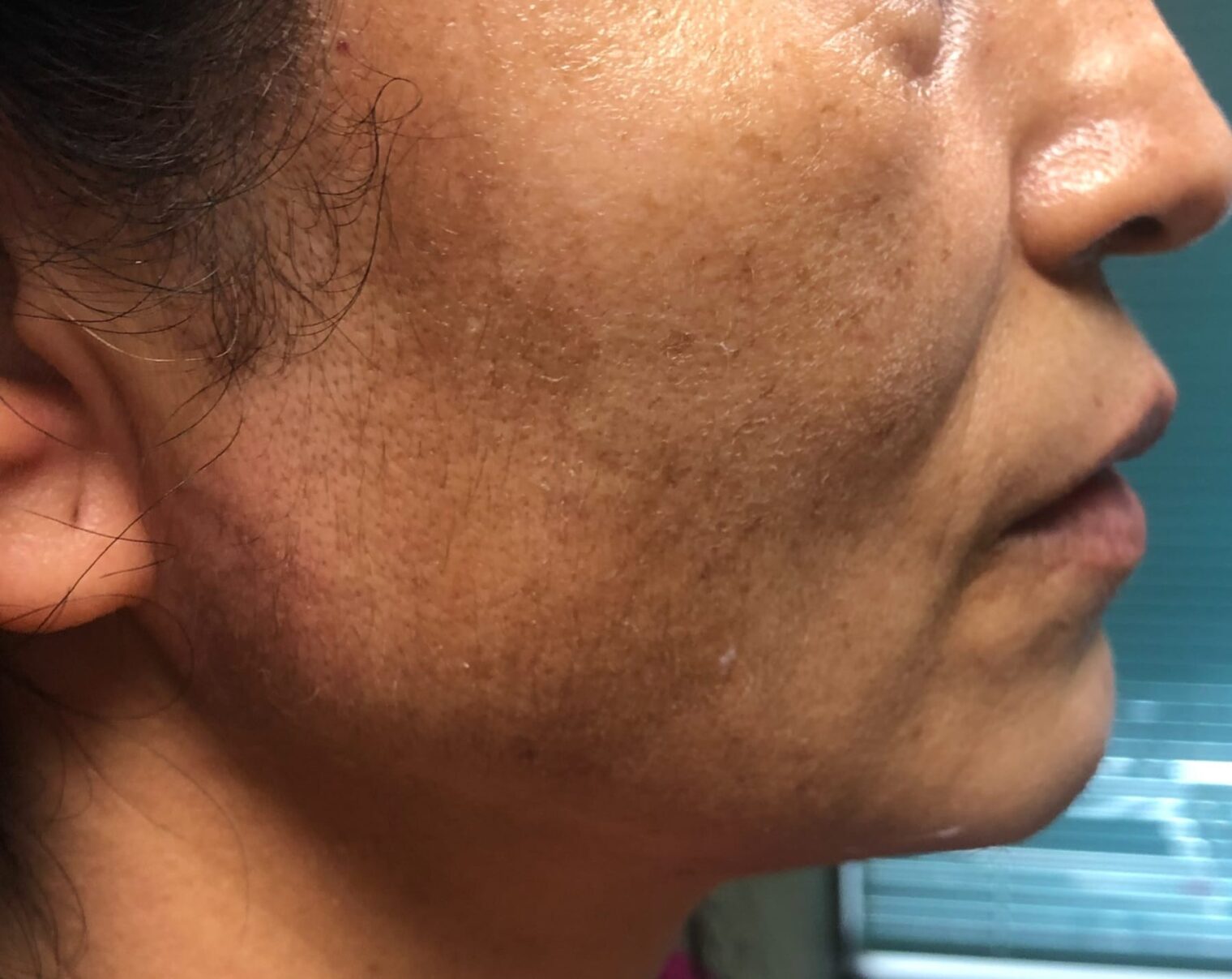 Fractional Laser Resurfacing Before