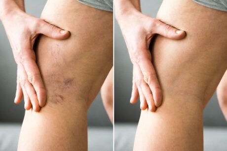 Spider Veins Treatment