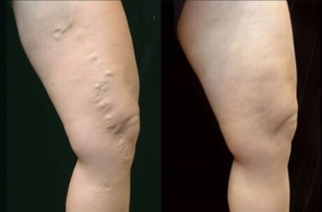 Varicose veins vs. spider veins