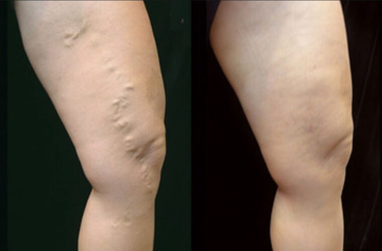 Before and After of Varicose Veins