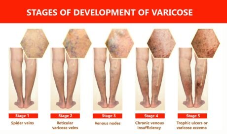 Varicose Vein Hereditary