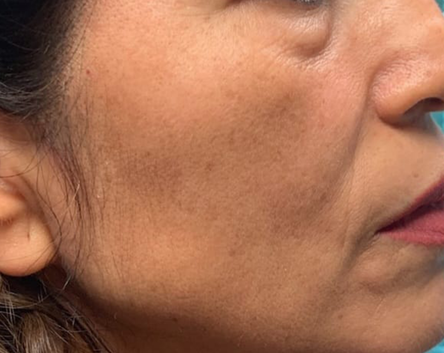 Fractional Laser Resurfacing After