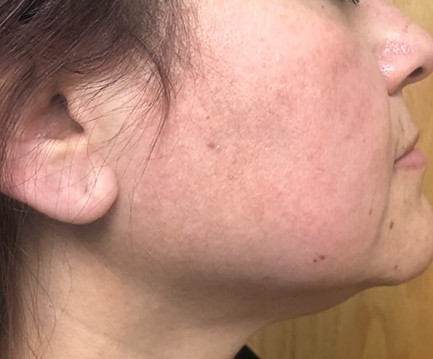 IPL Photofacial Treatment after