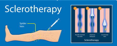 sclerotherapy