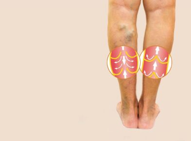 Local Recurrent Varicose Veins