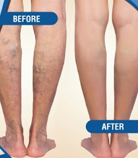 Local Vein Clinic in Illinois