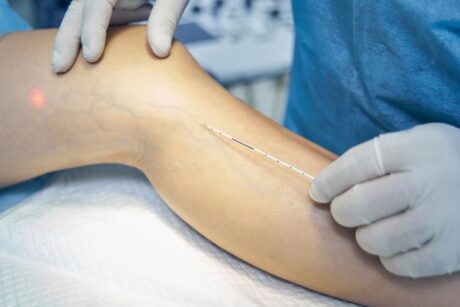 CAUSES OF VARICOSE VEINS