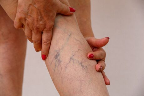 Varicose Veins Symptoms And Causes