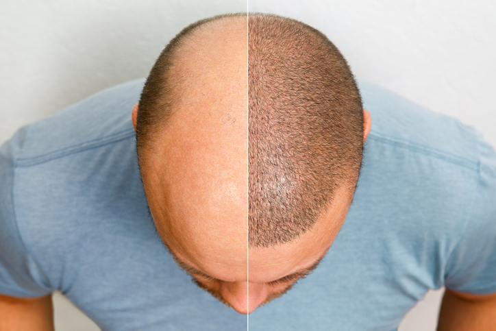 Hair Transplant in Oakbrook, IL