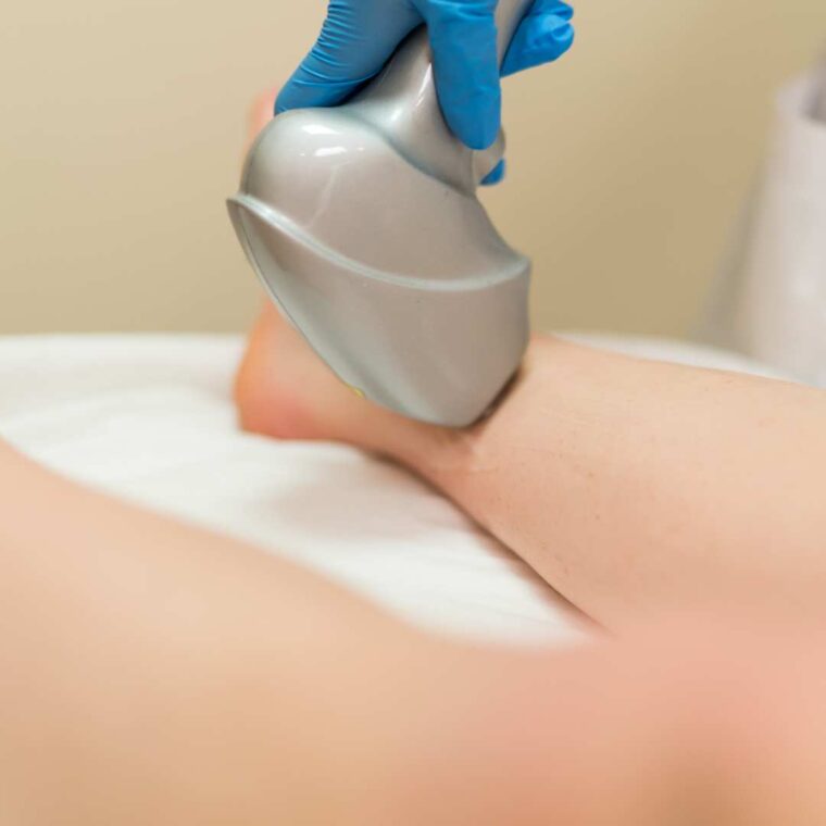 Veins Laser Treatment