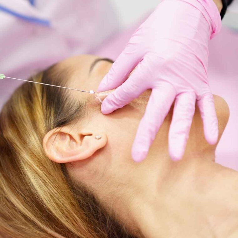 PDO Threads on the face