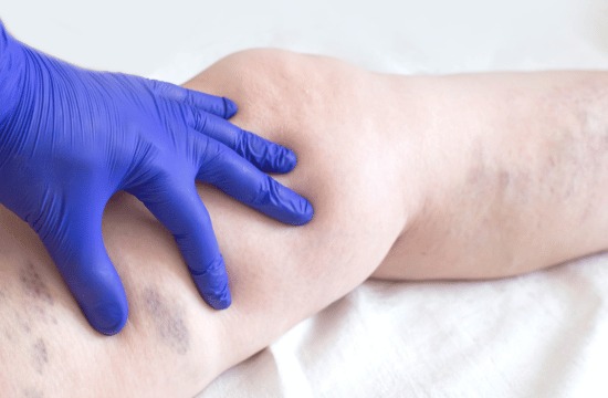 Varicose Veins Lifestyle Changes