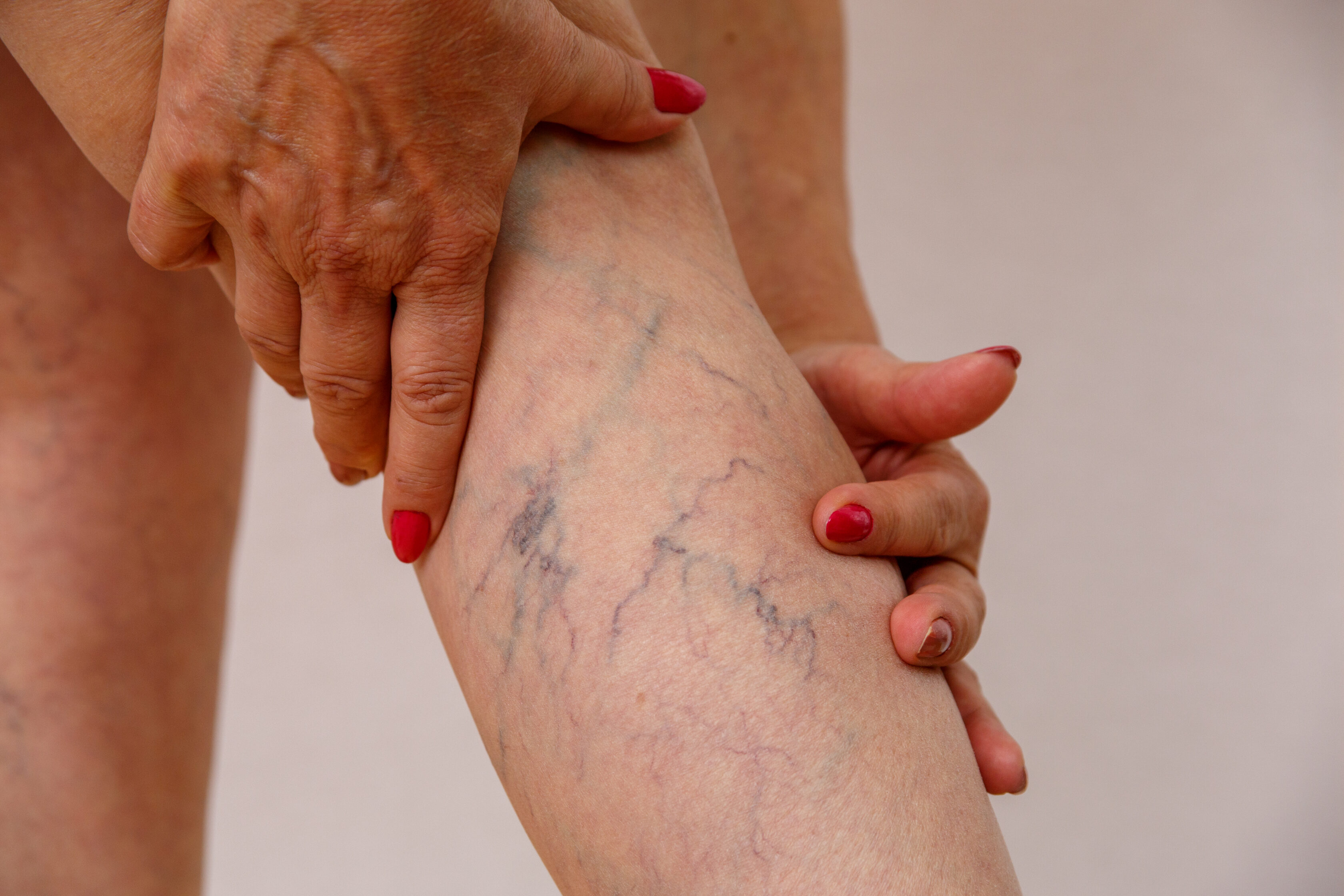 The best Varicose Vein Treatment Near Me
