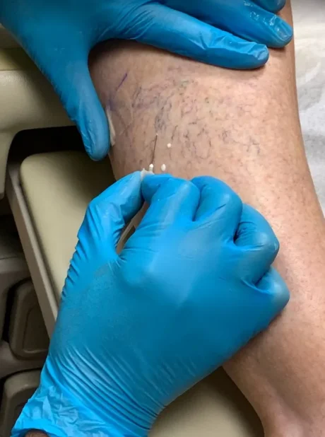 what is sclerotherapy What is Sclerotherapy A Simple Solution to Vein Problems