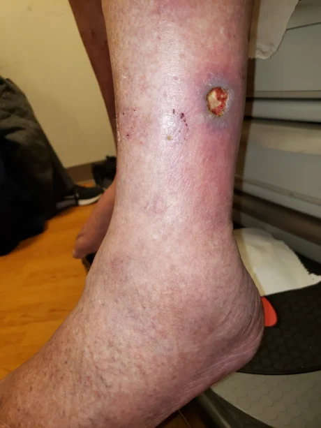 varicose veins symptoms Varicose Veins Symptoms Every Doctor Should Recognize