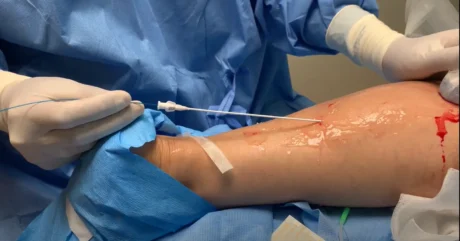 Spider veins What Are the Best Treatments for Spider Veins Today?