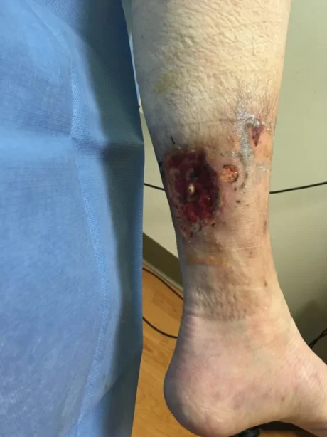 varicose veins symptoms Varicose Veins Symptoms Every Doctor Should Recognize