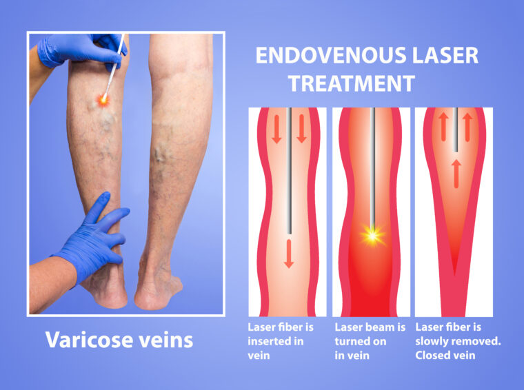 The best Varicose Veins Laser Treatment