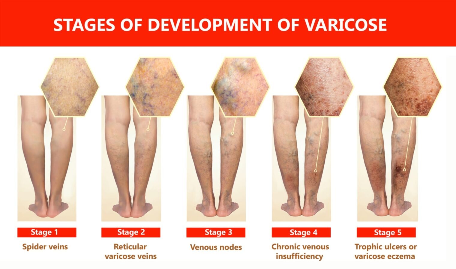 What Happens During a Vein Screening 1 The Vein Center Near Me