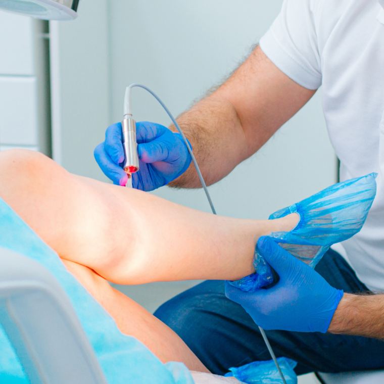 Spider Vein Laser Therapy