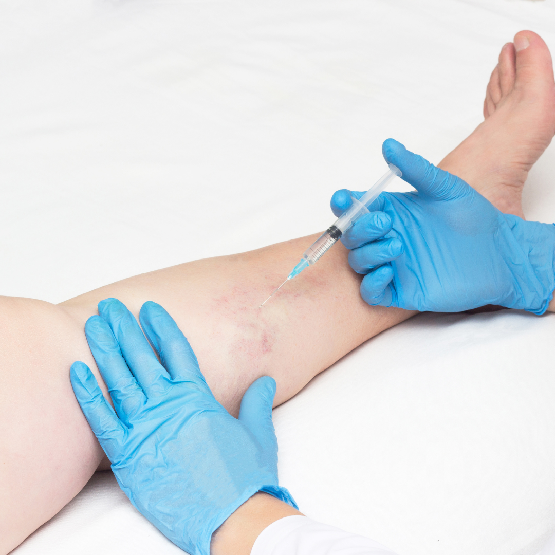 Varicose Veins Removal