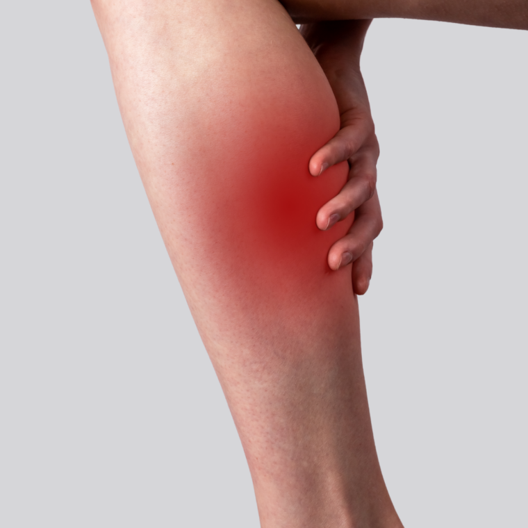 Varicose Veins Are important to consider