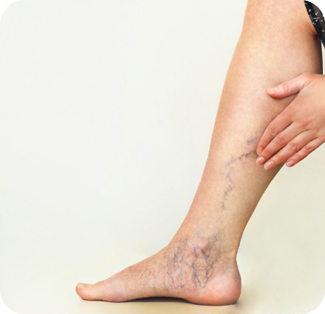 Veins Treatment