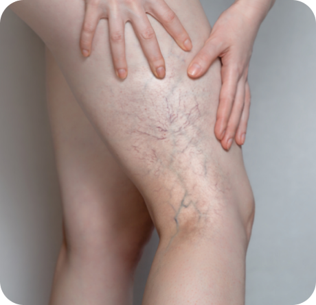 Varicose Treatment