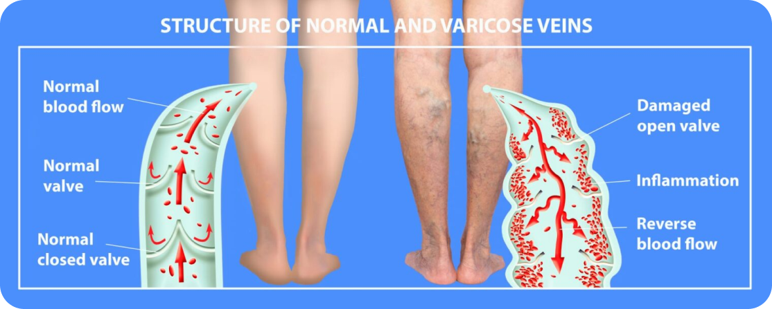 Structure of Normal And Varicose Veins
