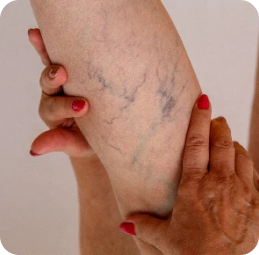 Charming Skin Vein Clinics Varicose Guide for Massage