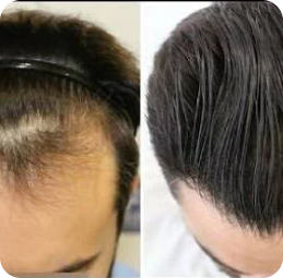 Charming Skin Vein Clinics Hair Restoration