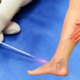 EVLA Treatment for Varicose Veins