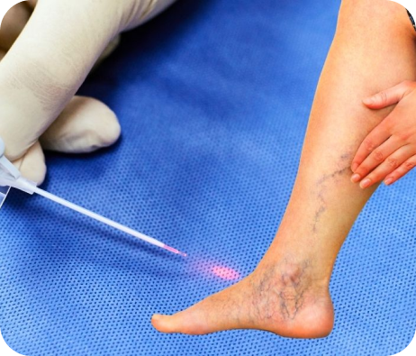 EVLA Treatment for Varicose Veins