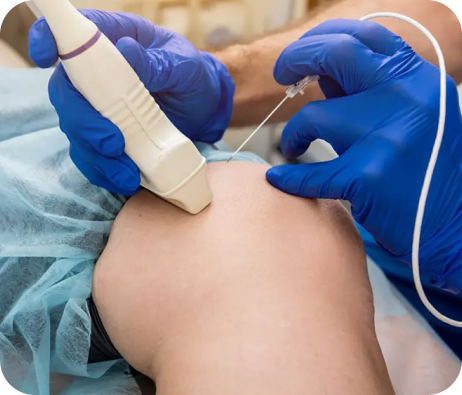 EVLA Treatment for skin