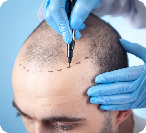 Hair Restoration with ALMI