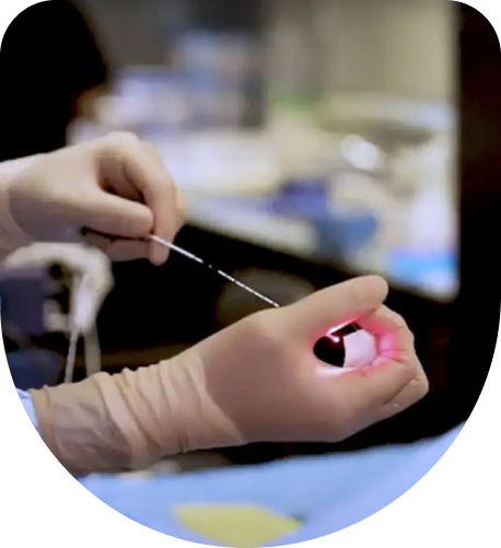 EVLA Treatment for hand