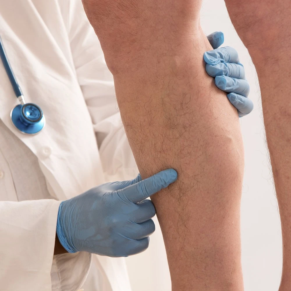Varicose Veins Screening Consult