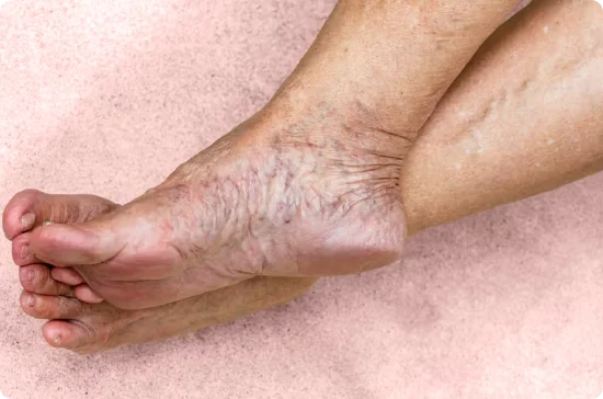 Dark Veins showing in the foot