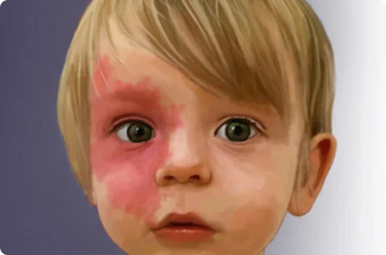 Kid having big red rashes in the face