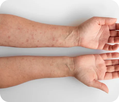 Spider Veins Symptoms