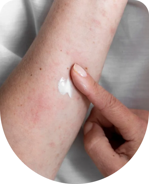 Applying Cream to a Spider Veins