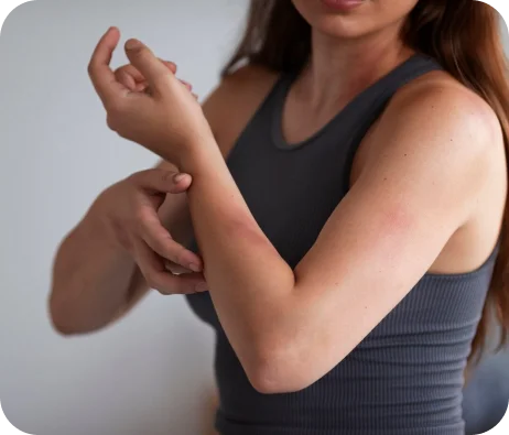 Spider veins in the arm