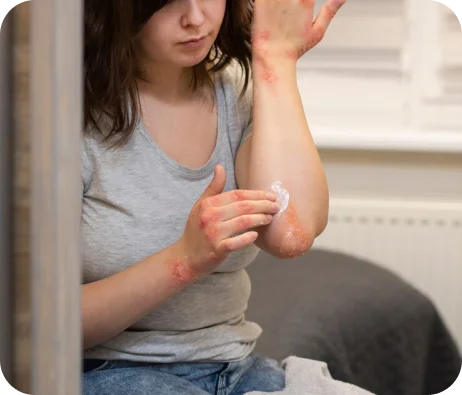 Spider Veins in the elbow